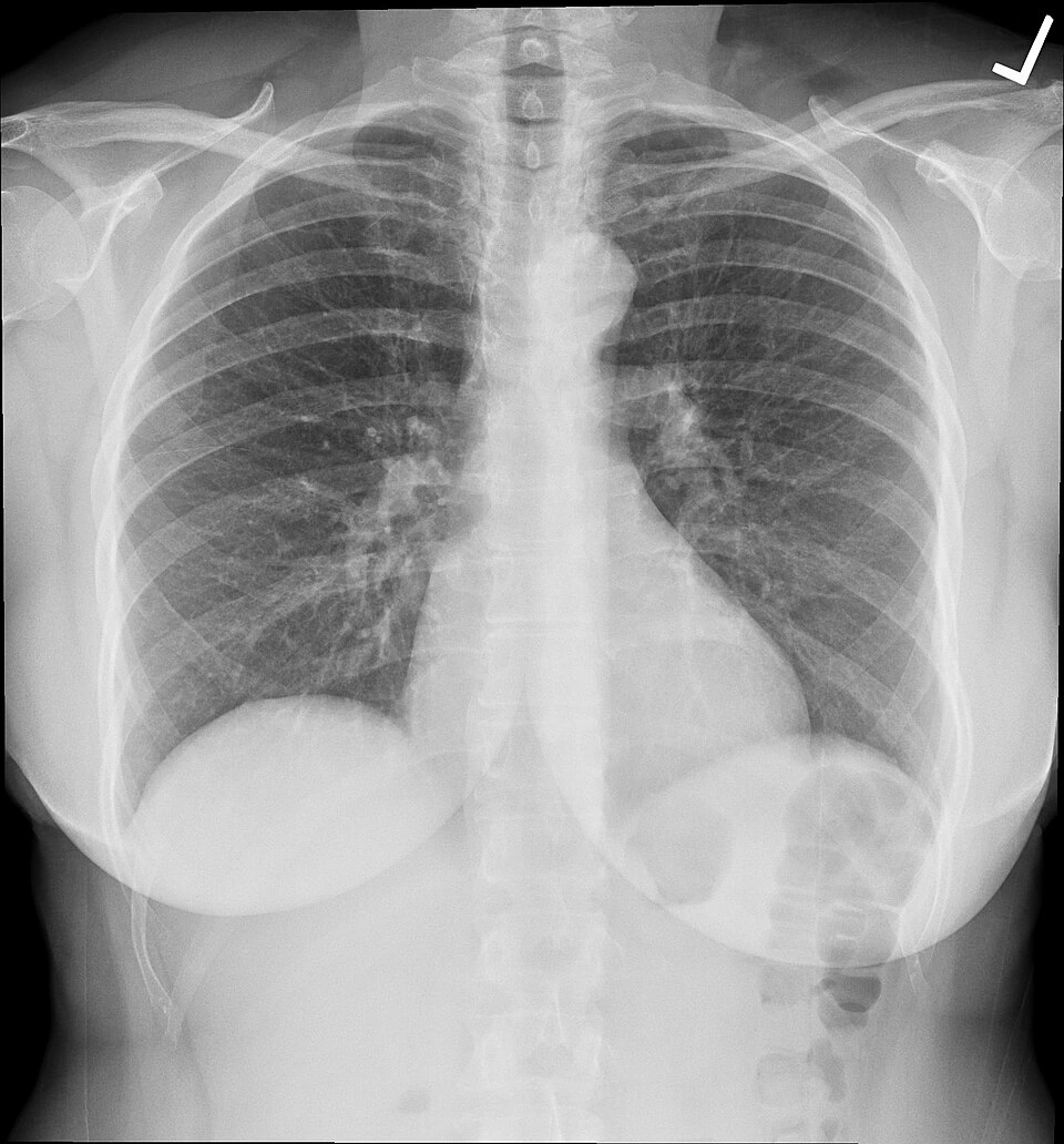 Archivo: radiografía torácica descrita por su autor como normal, 20 de noviembre de 2017. Contexto de las imágenes que analizan sistemas de apoyo a la detección de tuberculosis; no muestra un diagnóstico ni software precalificado.